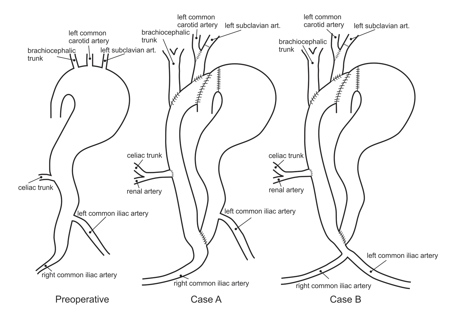 Schematic presentation of the preoperative and two post-operative cases A and B for extra-anatomic reconstruction and thromboexclusion for specific patient