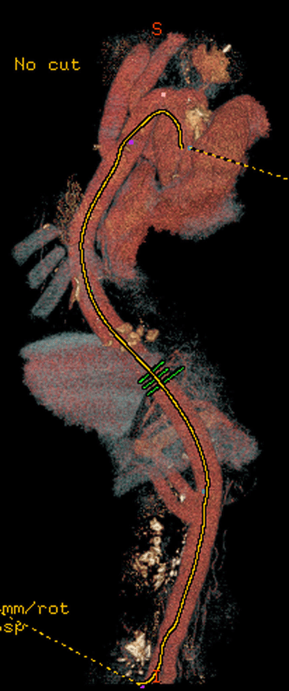 Thromboexclusion of the aorta with extra-anatomic aortic bypass with reattached supra-aortic, visceral, and lower limb vessels