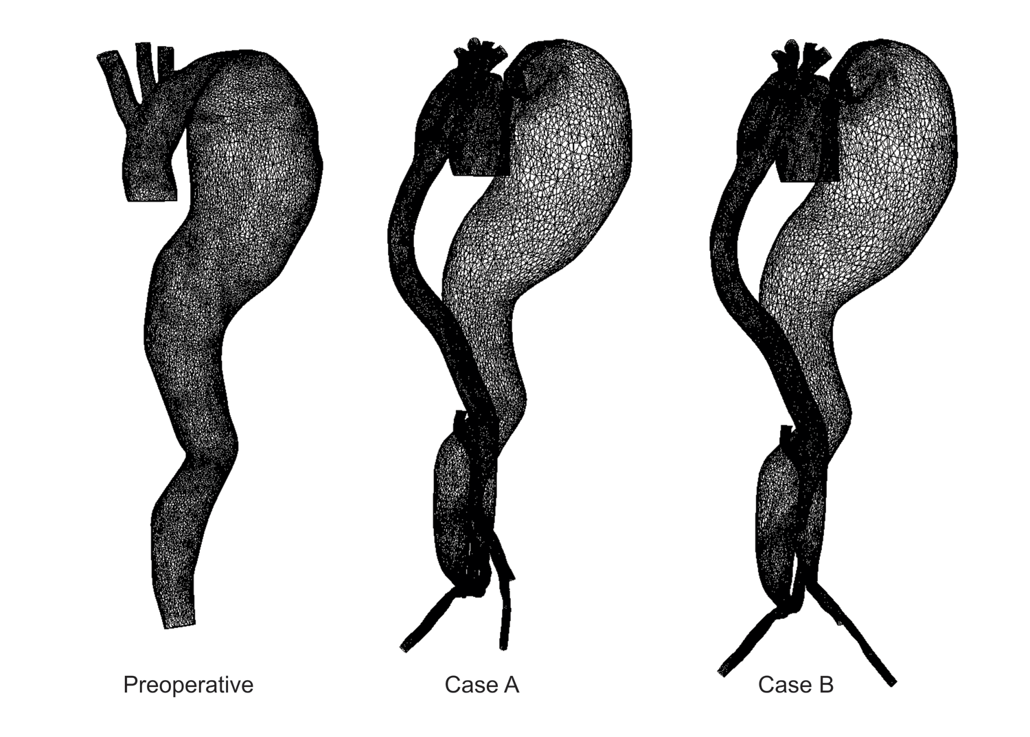 Finite element meshes for preoperative and two postoperative cases A and B