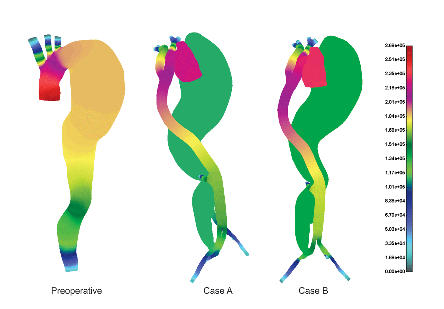 Pressure distribution for the cases before and after the treatment (dyn/cm2)