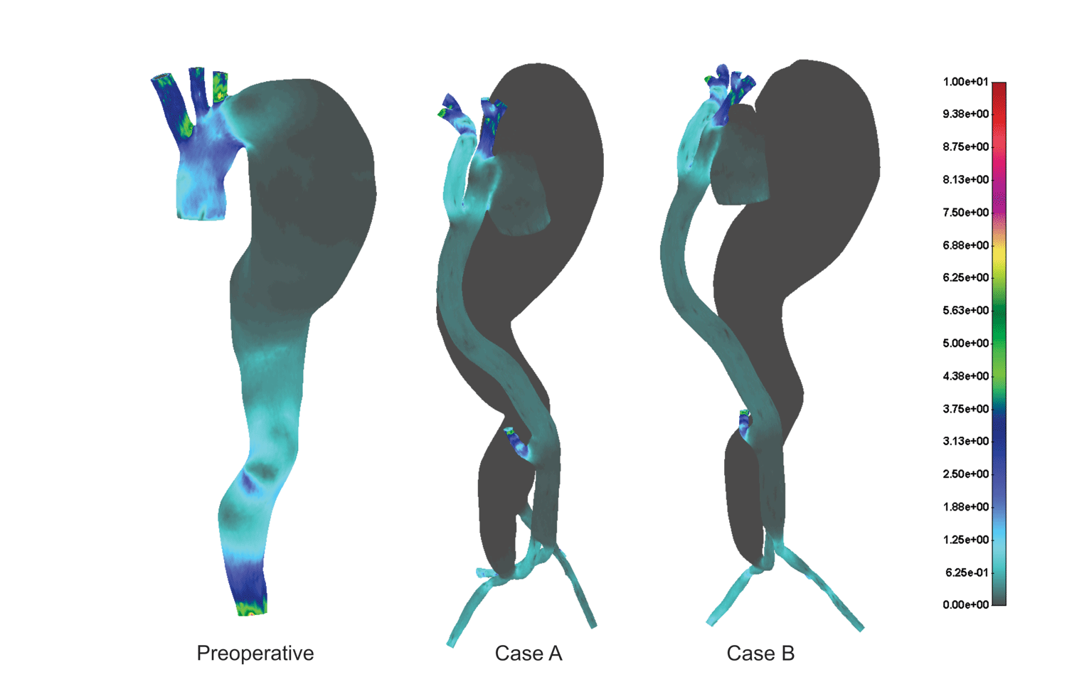 Shear stress distribution for the cases before and after the treatment(dyn/cm2)