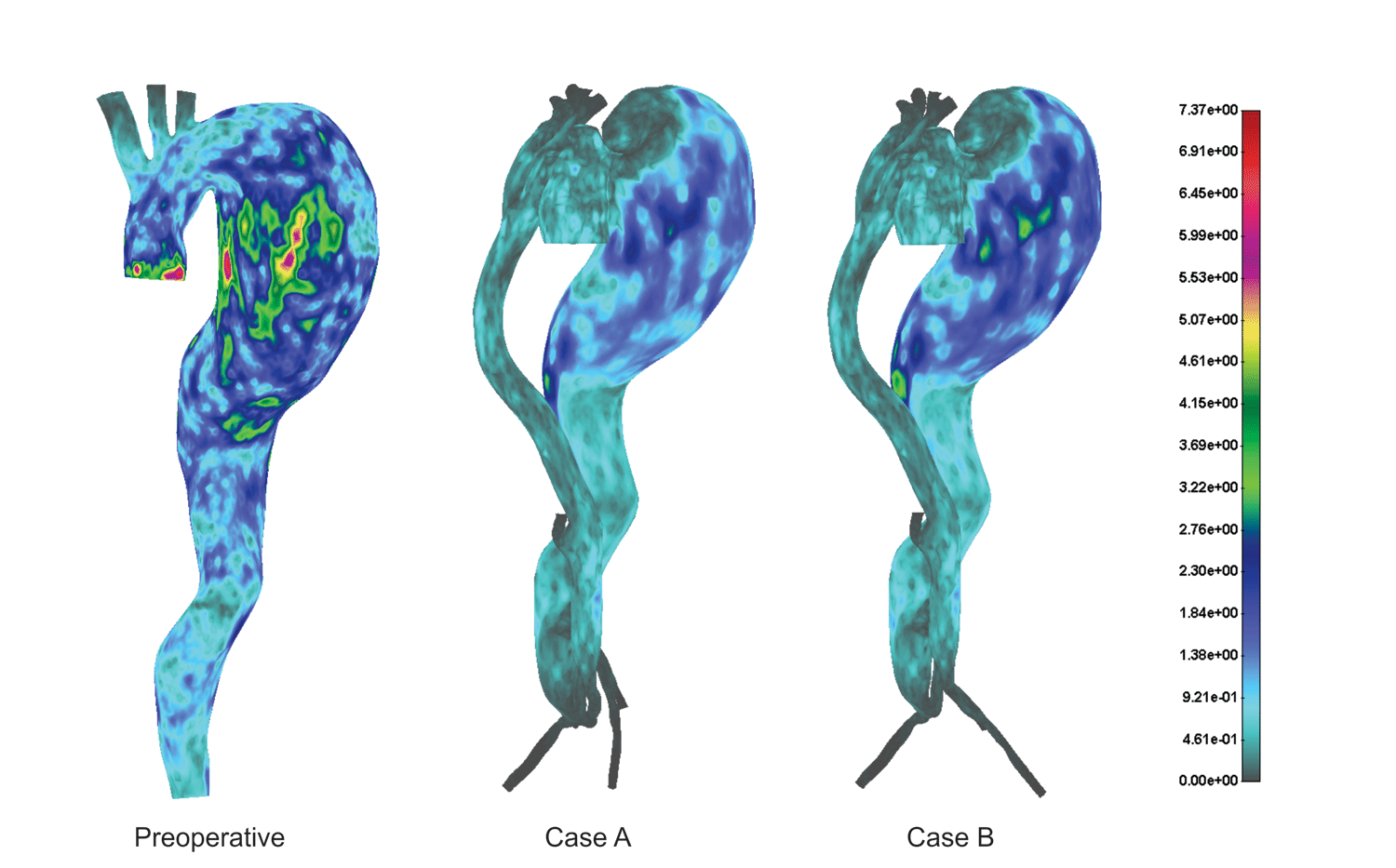 Drag force distribution for preoperative and two postoperative cases A and B (N)