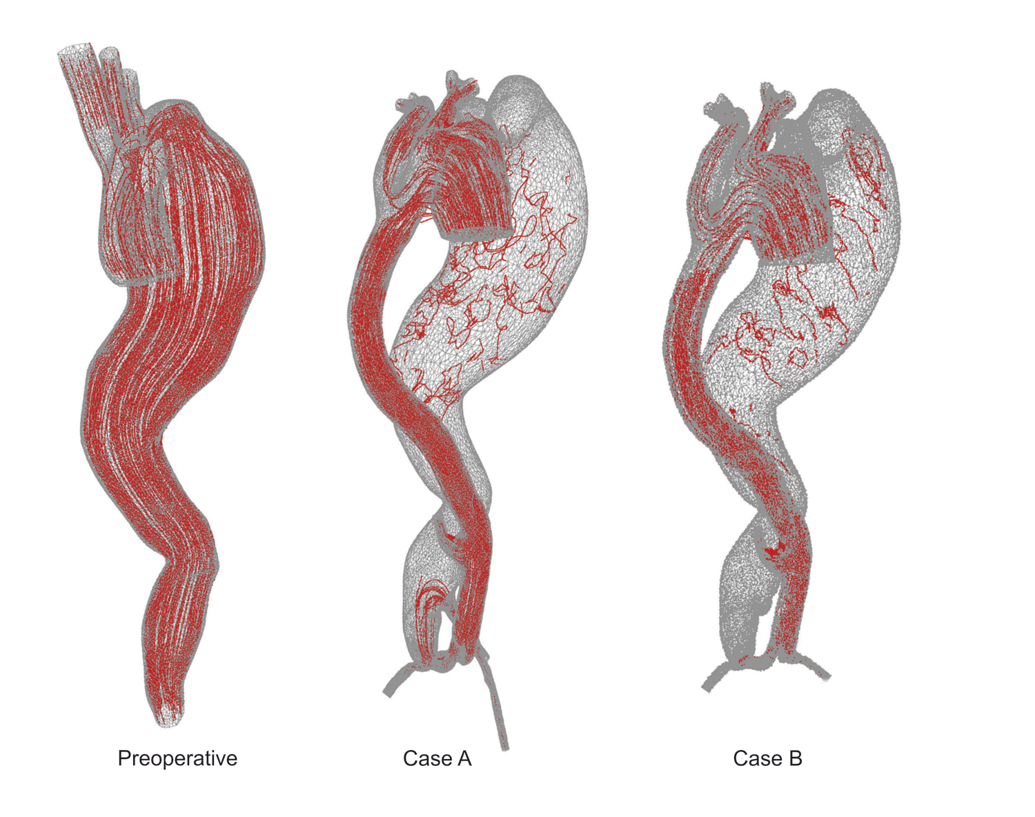 Streamlines distribution for preoperative and two postoperative cases A and B